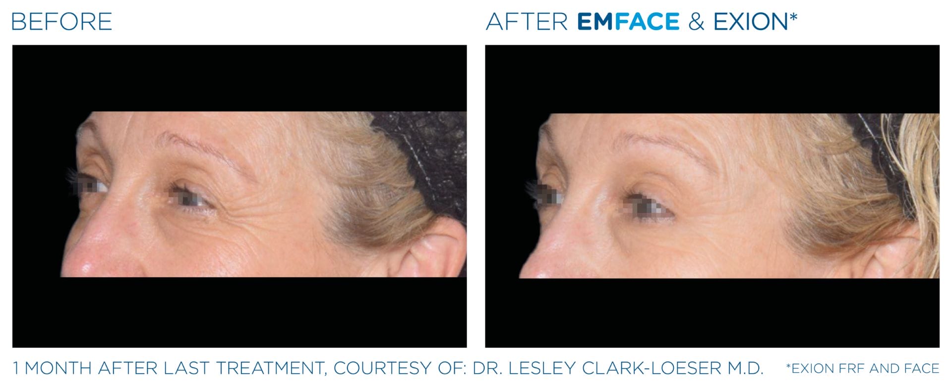 Emface_Exion_PIC_Ba-card-eyes-female-002_FRF_Face_ENUS100