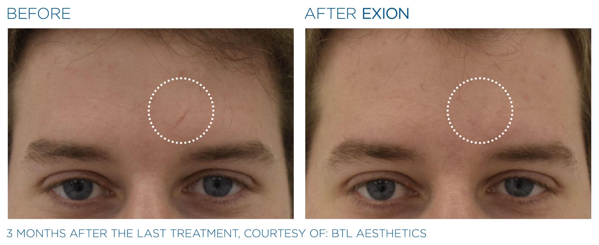 Exion_PIC_Ba-card-forehead-male-022_FRF_ENUS100