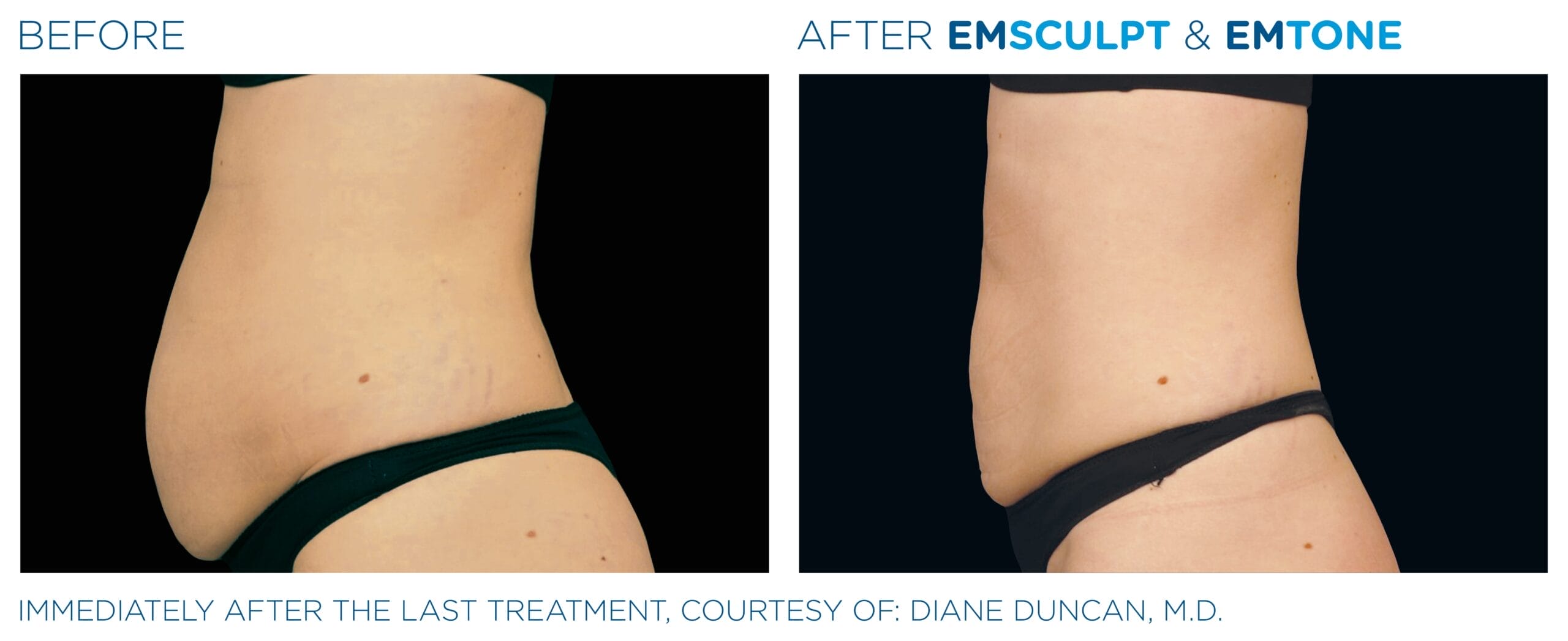 Emsculpt_Emtone_PIC_004_Ba-card-female-abdomen_ENUS100