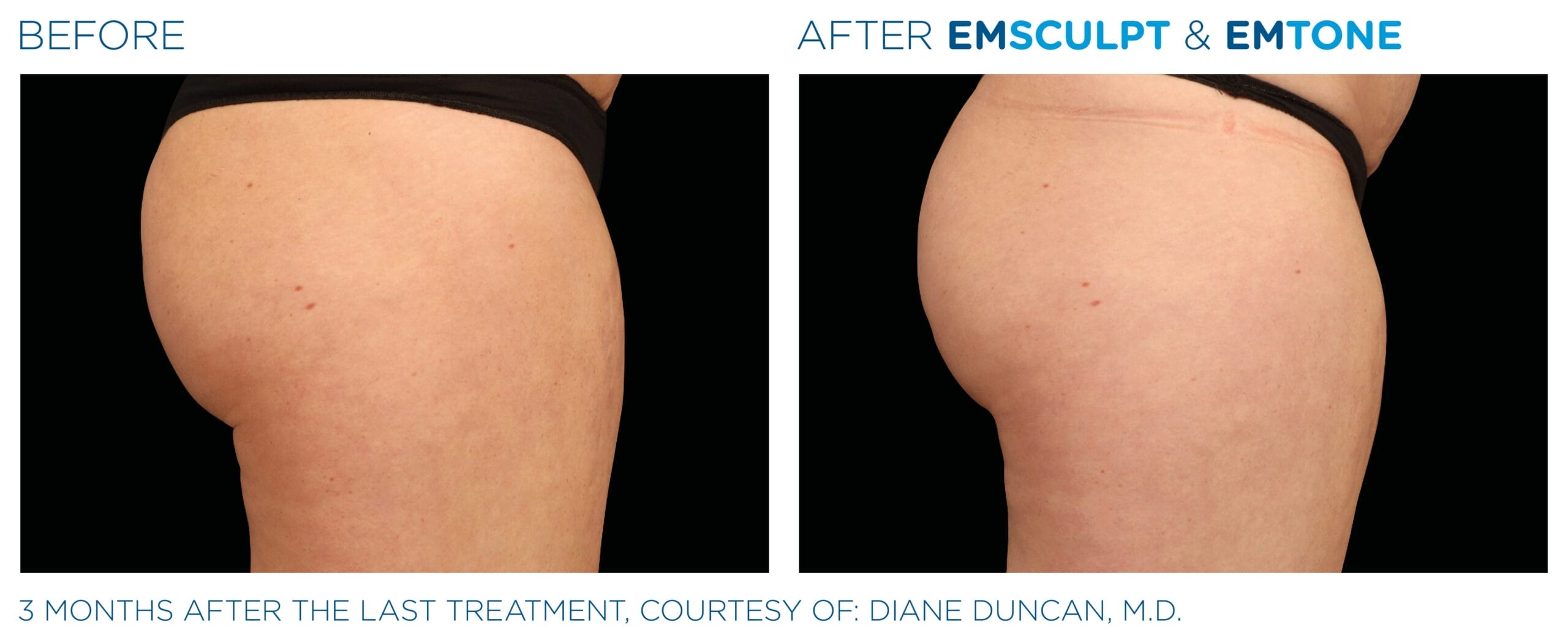 Emsculpt_Emtone_PIC_Ba-card-female-buttock-014_ENUS100
