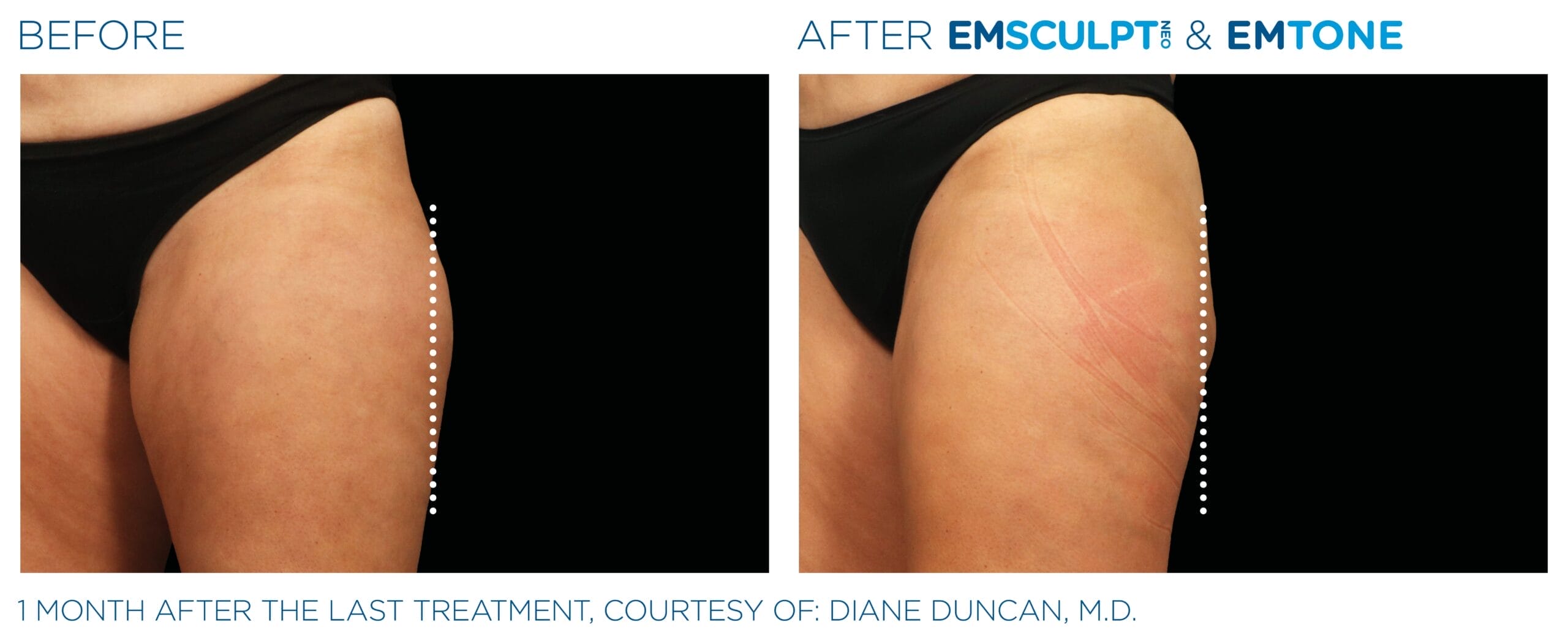 Emsculpt_Neo-Emtone_PIC_Ba-card-female-outer-thigh-006_ENUS100