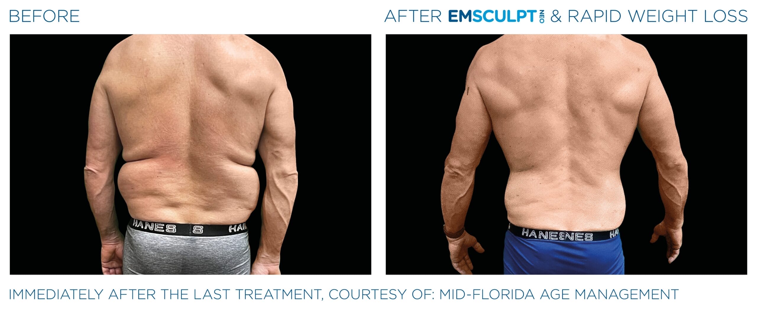 Emsculpt_Neo-Weight-Loss_PIC_Ba-card-male-lateral-abdomen-011_ENUS100