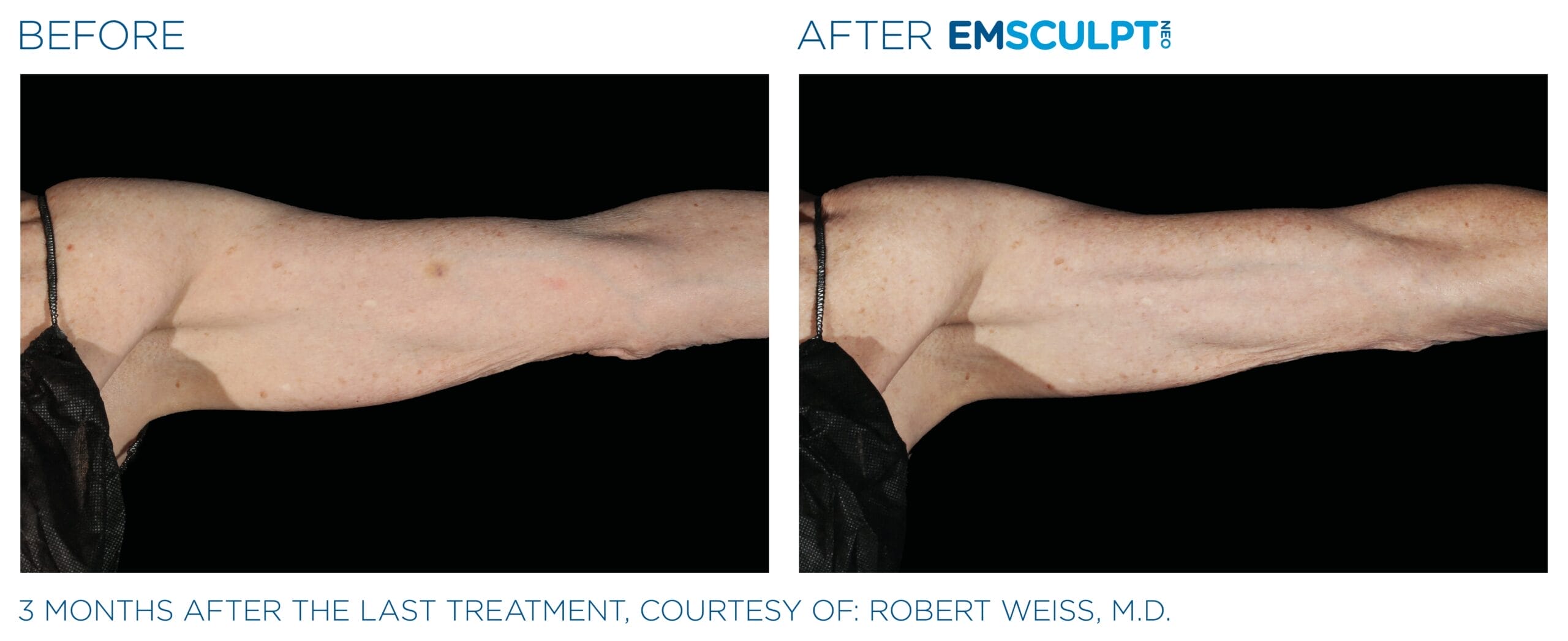 Emsculpt_Neo_PIC_Ba-card-female-arms-083_ENUS100