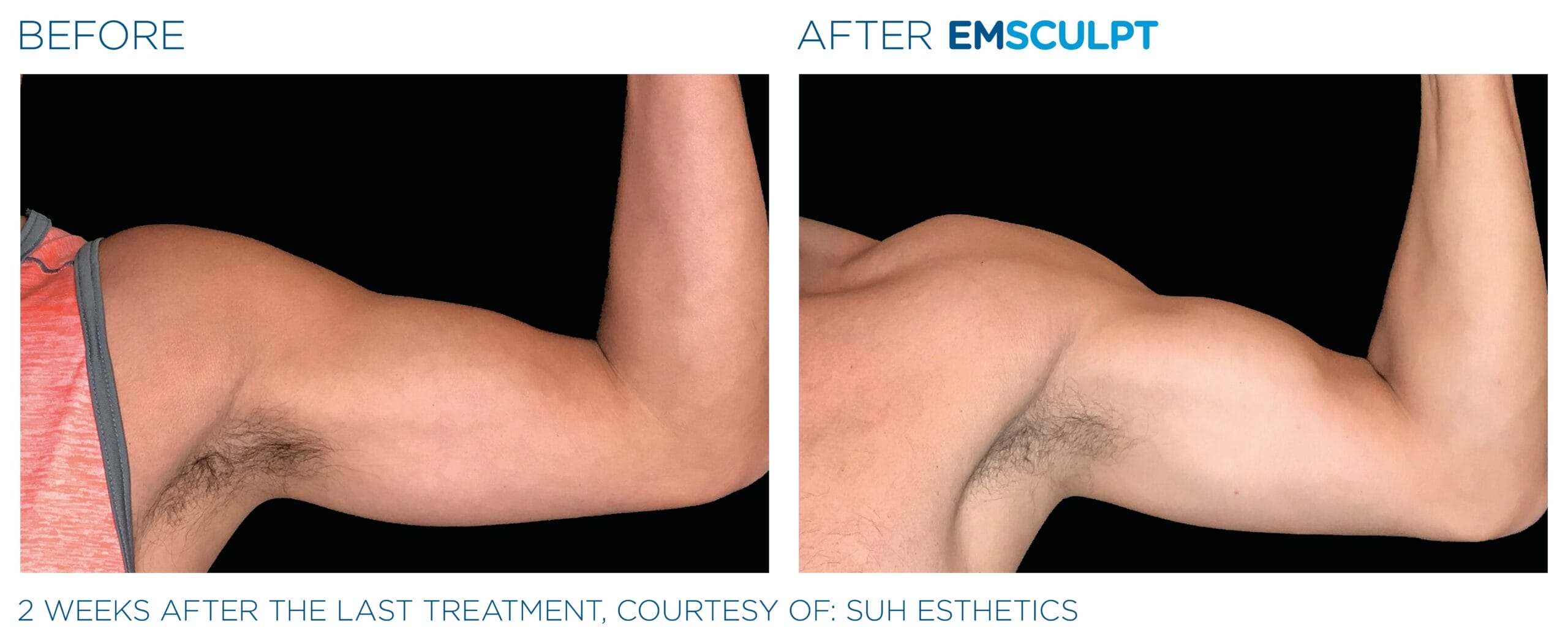Emsculpt_PIC_Ba-card-male-arms-121_ENUS100