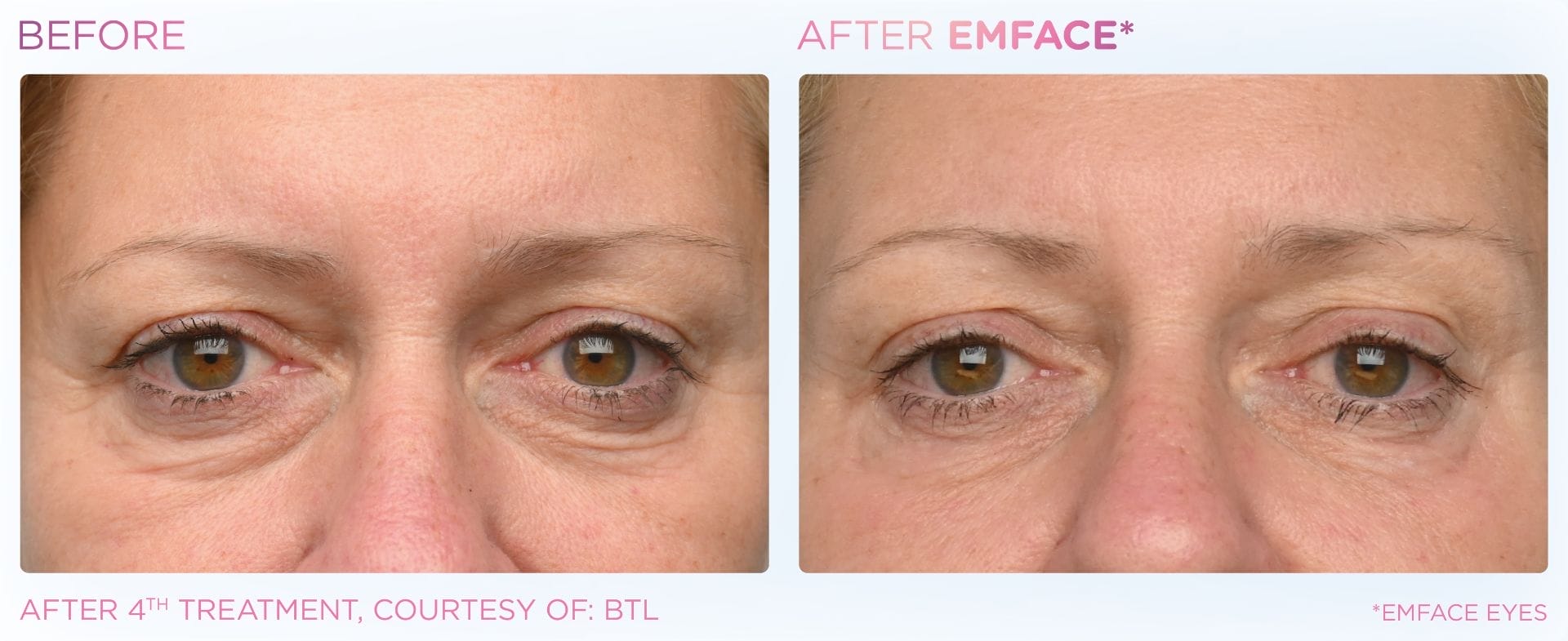 Emface_PIC_Ba-card-female-eyes-160_ENUS100
