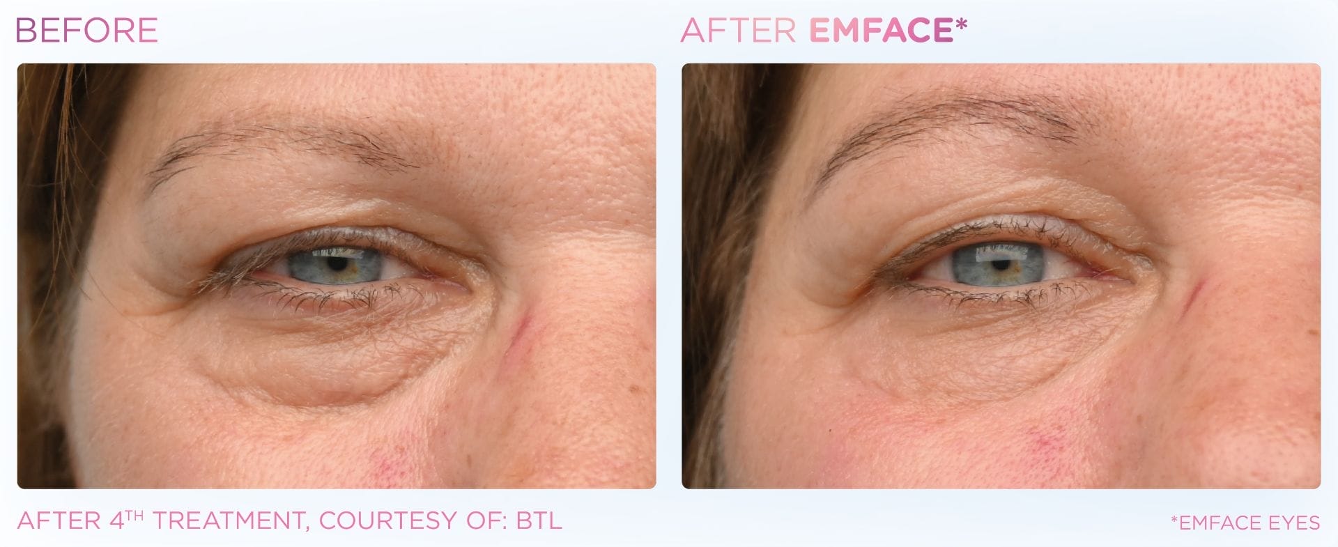 Emface_PIC_Ba-card-female-eyes-162_ENUS100