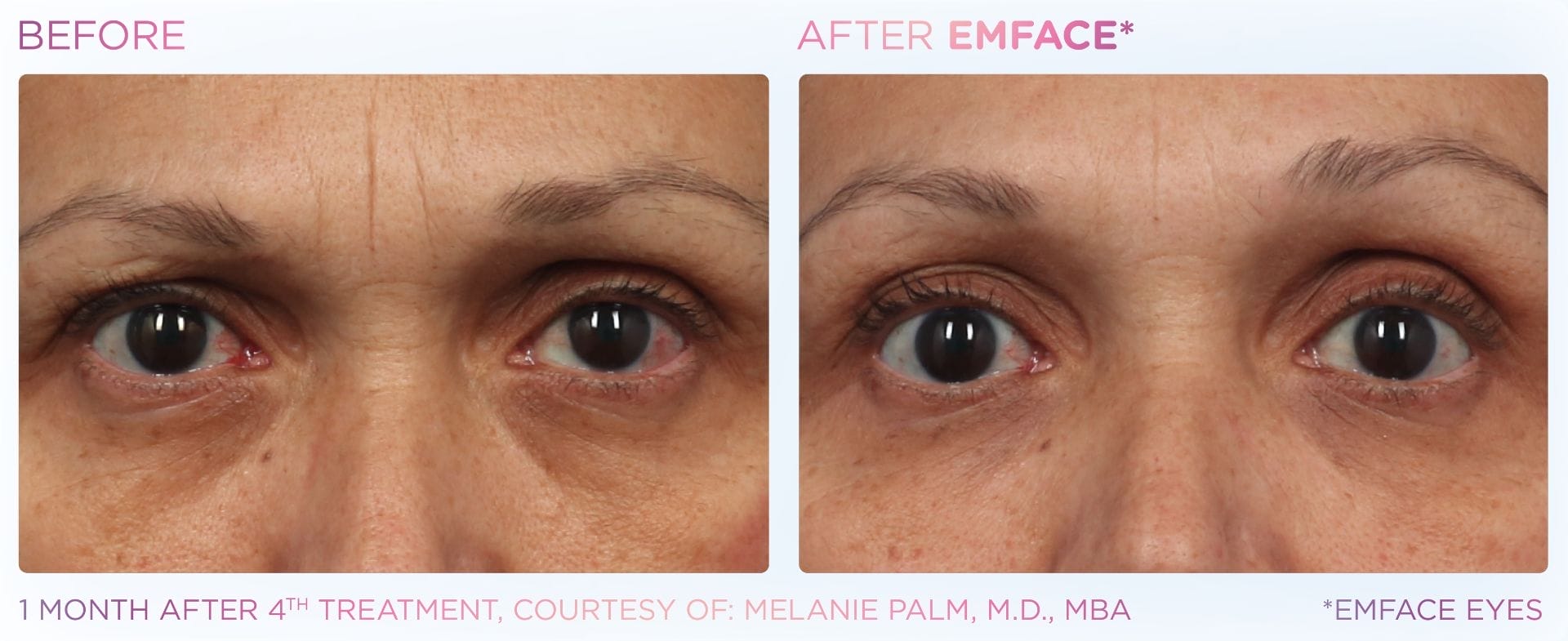 Emface_PIC_Ba-card-female-eyes-172_ENUS100