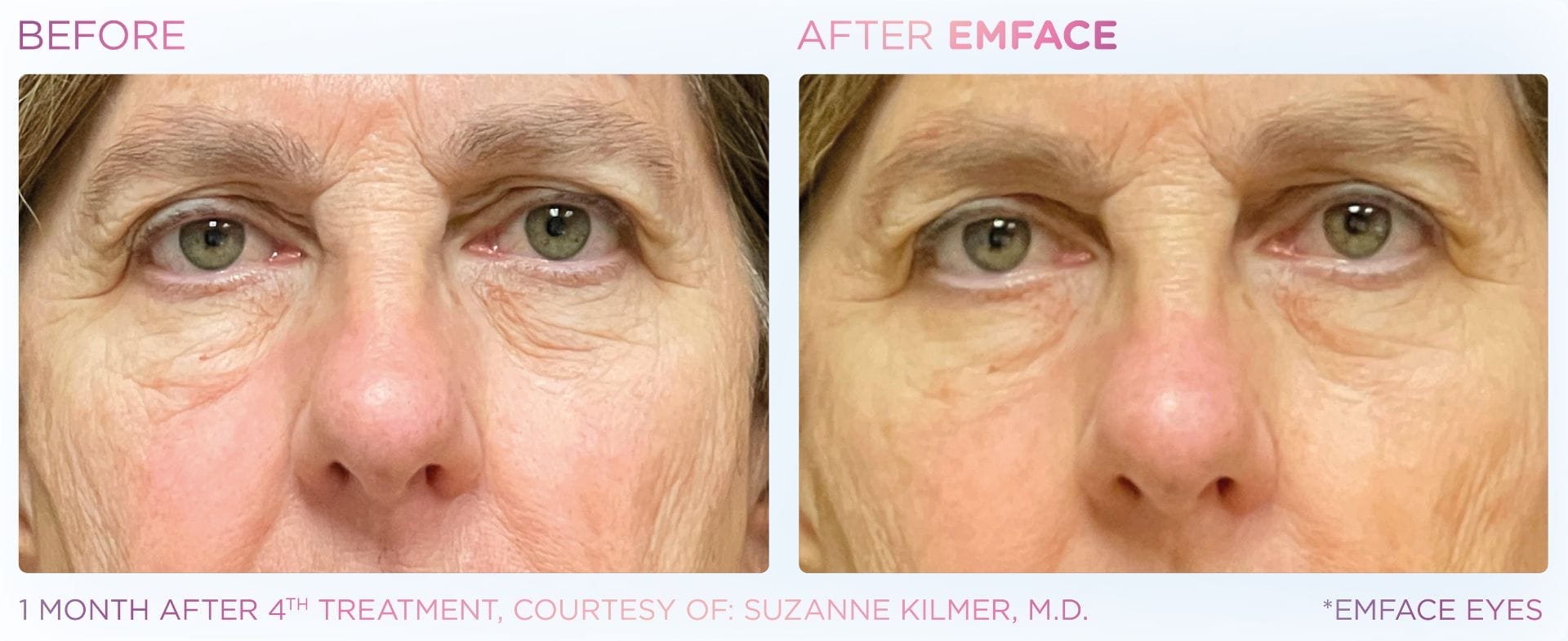 Emface_PIC_Ba-card-female-eyes-175_ENUS100